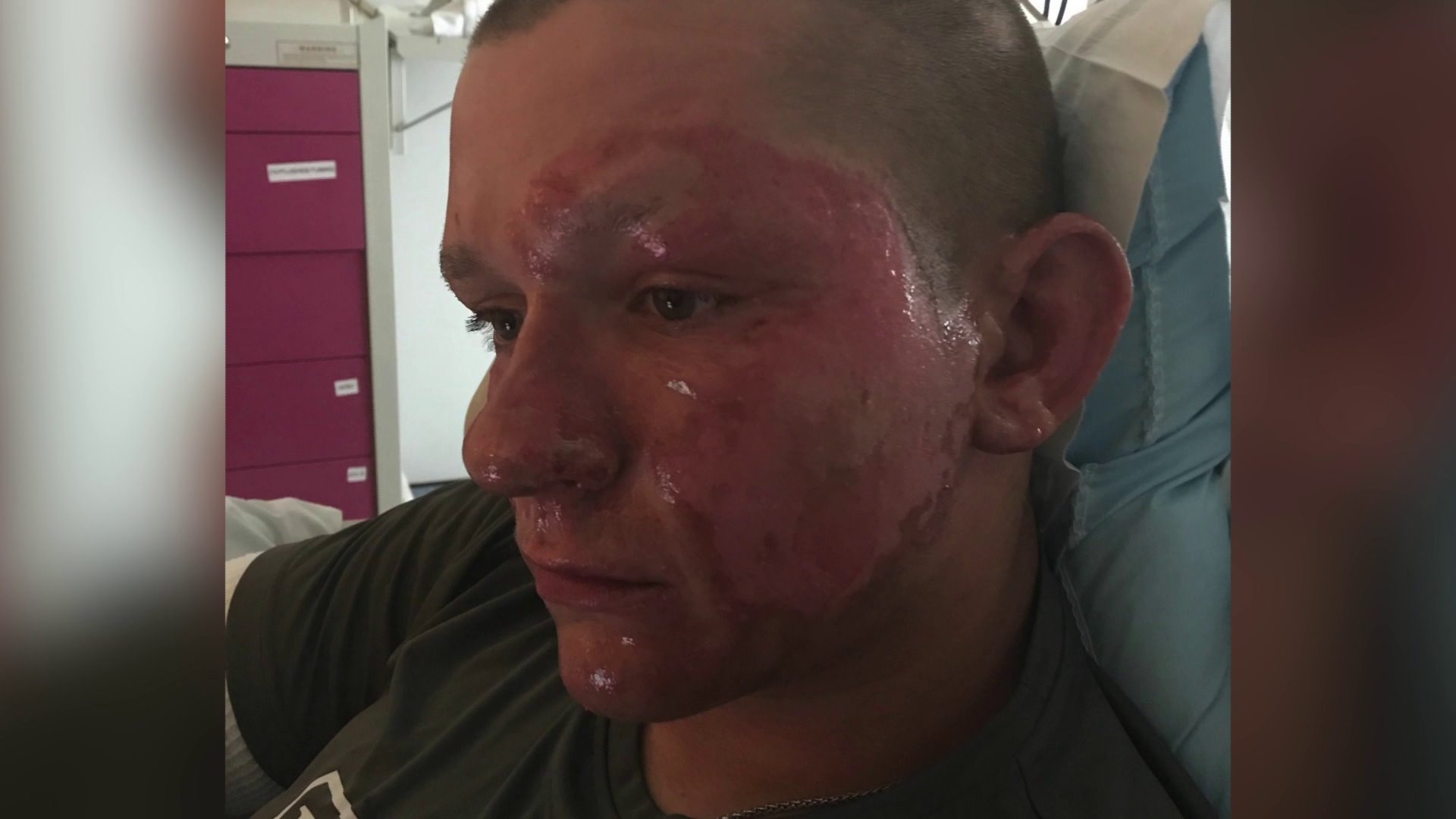 Giant Hogweed plant burns teen landscaper